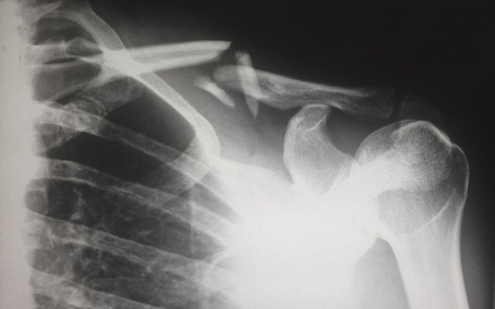 X-ray showing bone structure