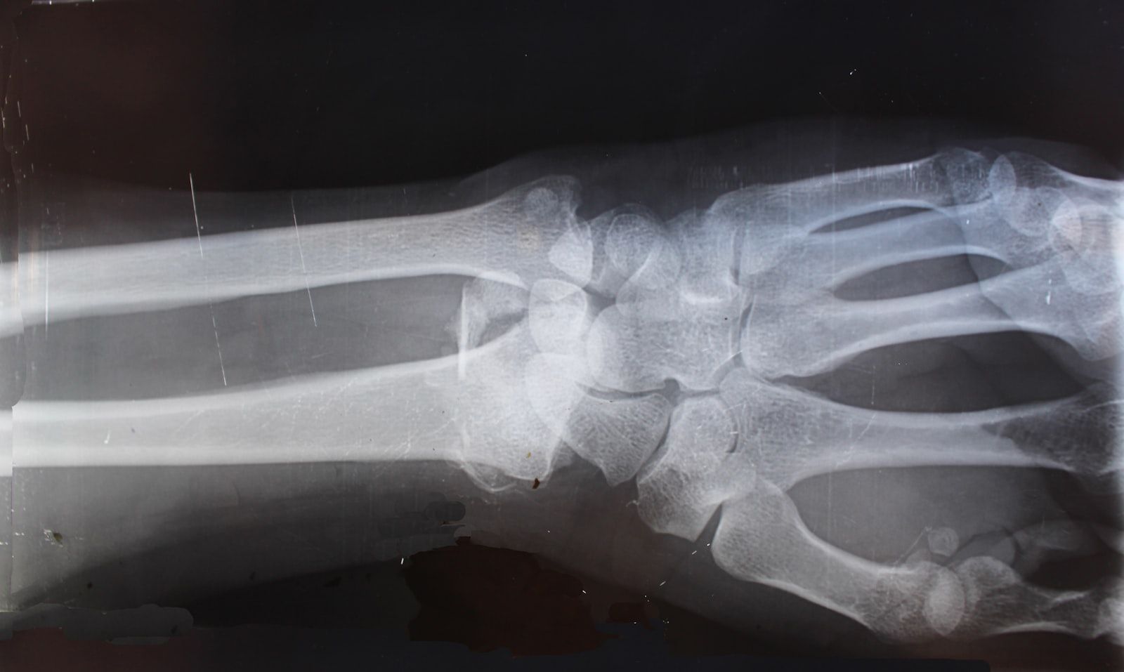 Wrist X-ray showing bone structure